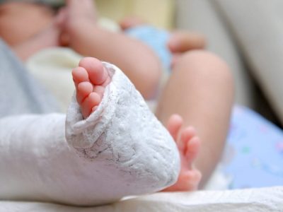 Can clubfoot be corrected